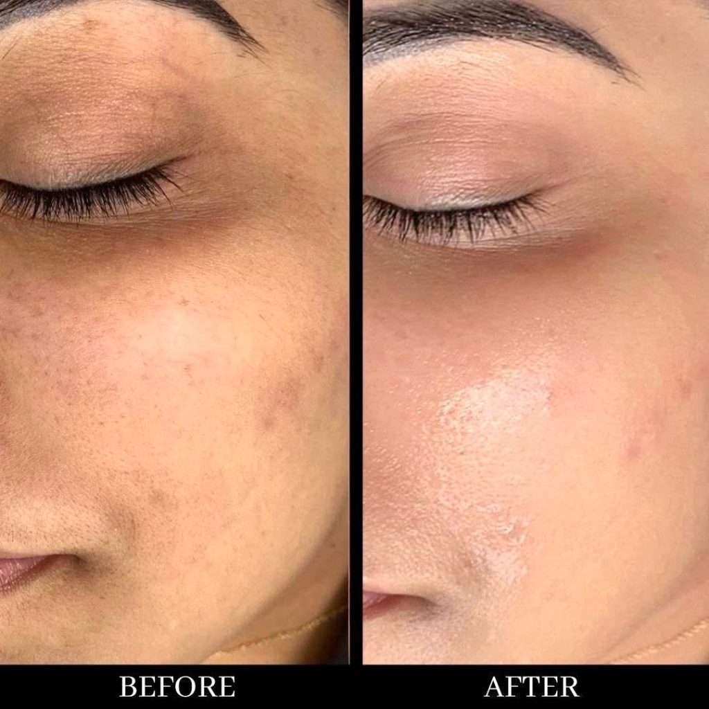 Skin Needling (Microneedling)