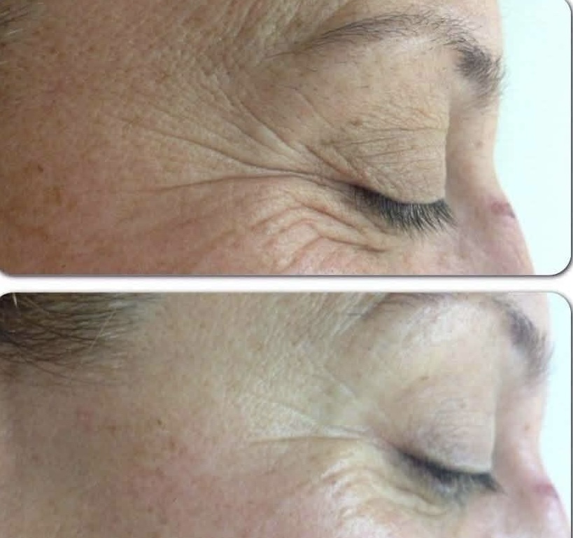 Clinical Chemical Peel & Facial Treatment