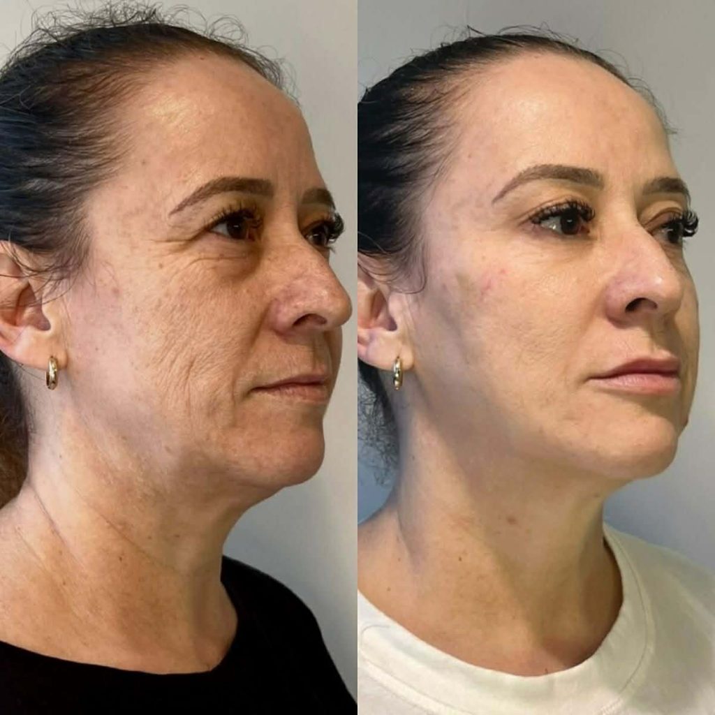 Non-Surgical Sculpting
