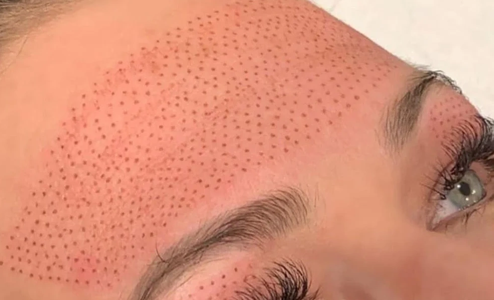 Plasma Skin Tightening (Fibroblast)