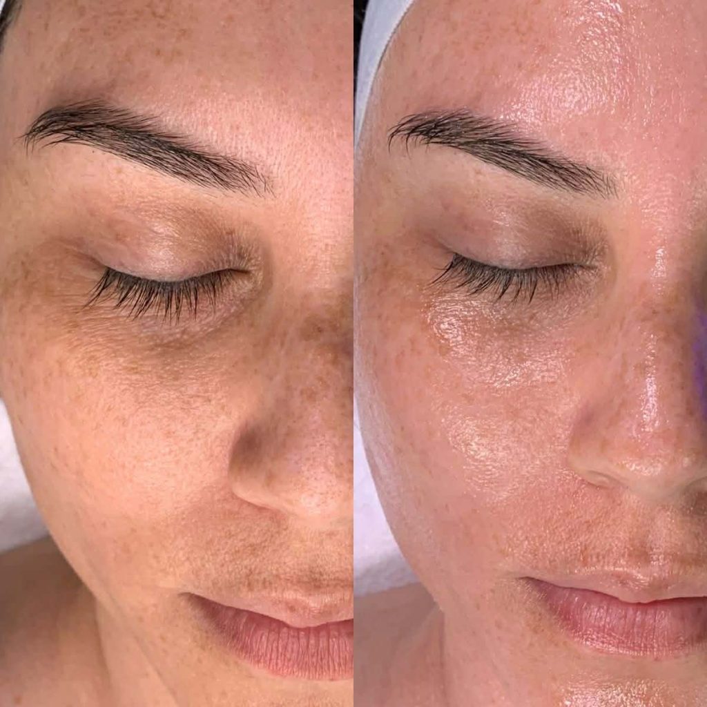 Advanced Hydra-Deluxe Facial
